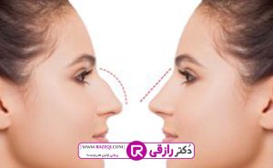 جراحی بینی گوشتی به چه صورت است؟